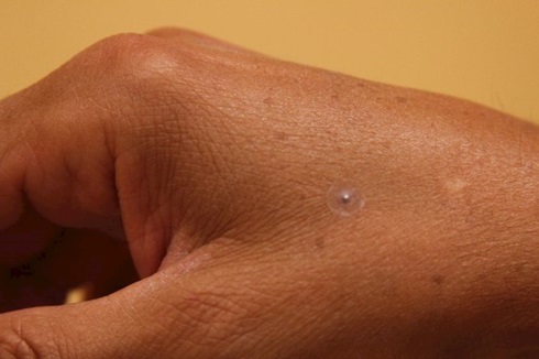 Microesferas Acupatch X 300